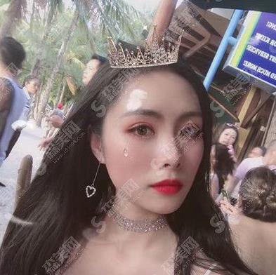 双眼皮整容医院哪家较靠谱?揭露上海华美双眼皮案例展示及价格公布