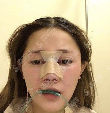 北京八大处假体隆鼻1到7天恢复图?价格参考出炉