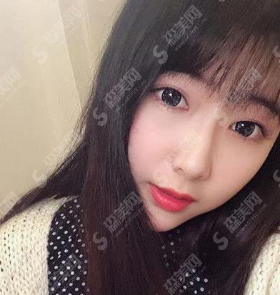 北京八大处假体隆鼻1到7天恢复图?价格参考出炉