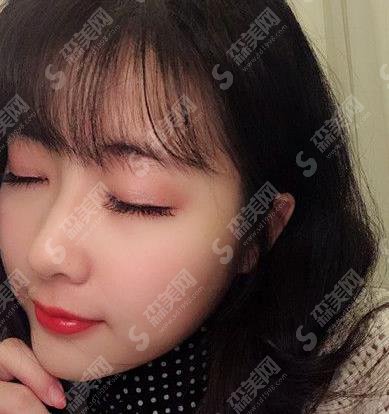 北京八大处假体隆鼻1到7天恢复图?价格参考出炉