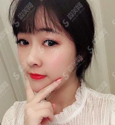 北京八大处假体隆鼻1到7天恢复图?价格参考出炉