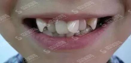 江门市口腔医院牙齿矫正多少钱?公布价格区间及成功案例