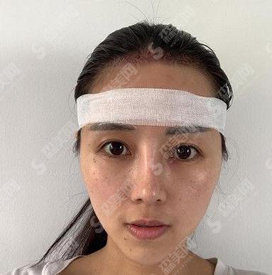 郑州华山医院植发怎么样?毛发移植术真实案例分享及价格参考