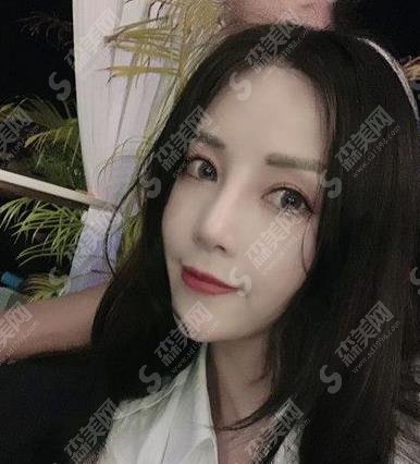 郑州华山医院植发怎么样?毛发移植术真实案例分享及价格参考