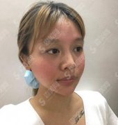 湘雅附三整形美容科热玛吉怎么样?含整形术后果对比照