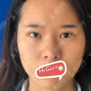 沈阳金皇后整形价目表查询!鼻整形的案例前后对比图分享