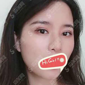 沈阳金皇后整形价目表查询!鼻整形的案例前后对比图分享
