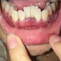 西安中诺口腔医院正规吗？西安中诺口腔医院牙齿矫正果案例对比图来了，还有价目表