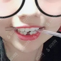 西安中诺口腔医院正规吗？西安中诺口腔医院牙齿矫正果案例对比图来了，还有价目表