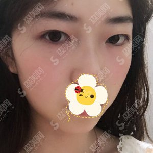 邯郸三院双眼皮价目表一览,双眼皮的手术果展示图分享!含新的整形价目表2021版