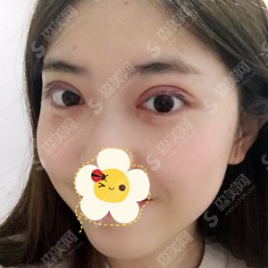 邯郸三院双眼皮价目表一览,双眼皮的手术果展示图分享!含新的整形价目表2021版