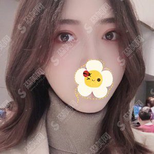 邯郸三院双眼皮价目表一览,双眼皮的手术果展示图分享!含新的整形价目表2021版