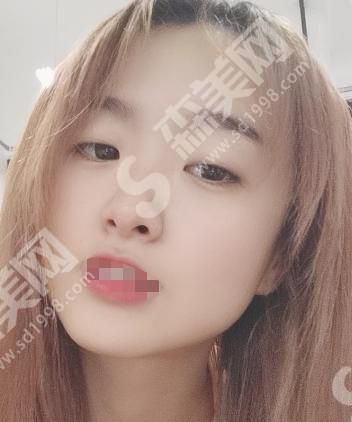 郑大一附院整形科做的双眼皮整形果怎么样?来看看果是你希望的吗?