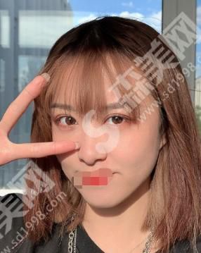 郑大一附院整形科做的双眼皮整形果怎么样?来看看果是你希望的吗?