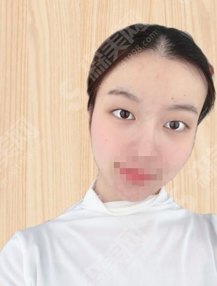 四川人民医院友谊医院整形科怎么样?双眼皮整形果来袭~