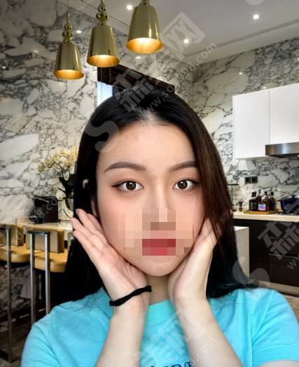 四川人民医院友谊医院整形科怎么样?双眼皮整形果来袭~