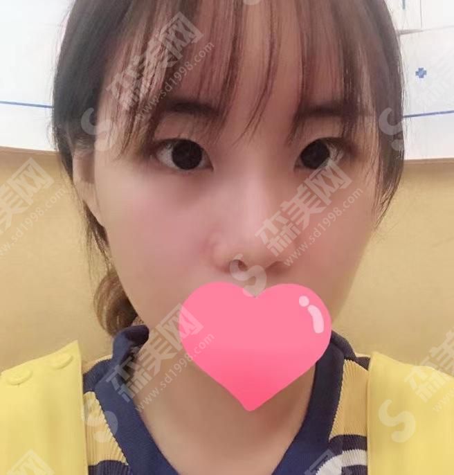 定州悦媛医疗美容院怎么样?医院做双眼皮果如何