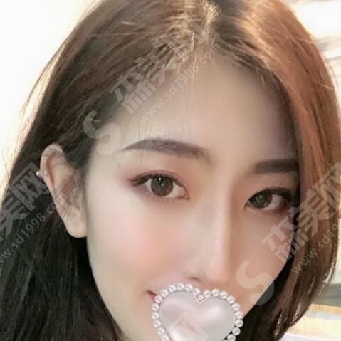 定州悦媛医疗美容院怎么样?医院做双眼皮果如何