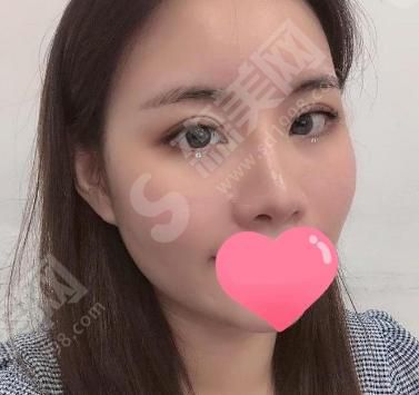 定州悦媛医疗美容院怎么样?医院做双眼皮果如何