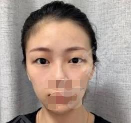 双眼皮整形哪家医院好呢?附广州涵茜尚美医疗双眼皮果分享