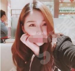 双眼皮整形哪家医院好呢?附广州涵茜尚美医疗双眼皮果分享