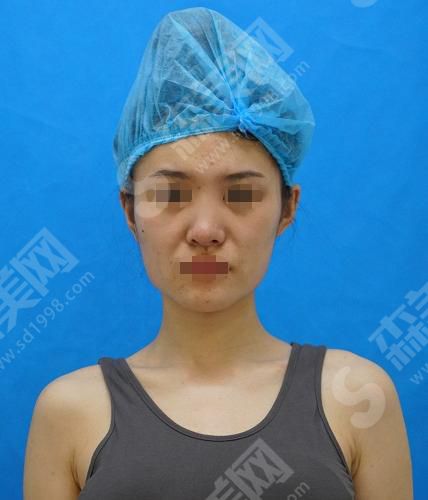 长沙爱思特医疗美容医院营业时间是什么时候？内含鼻部整形案例分享