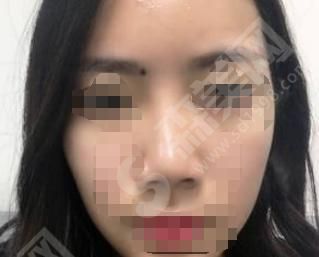 上海星璨整形医院正规吗？做鼻子做的好不好？