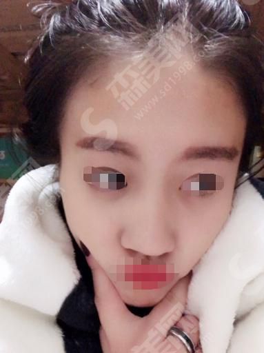临沂哪家整容医院的口碑好？内含临沂伊维美整形医院隆鼻果分享
