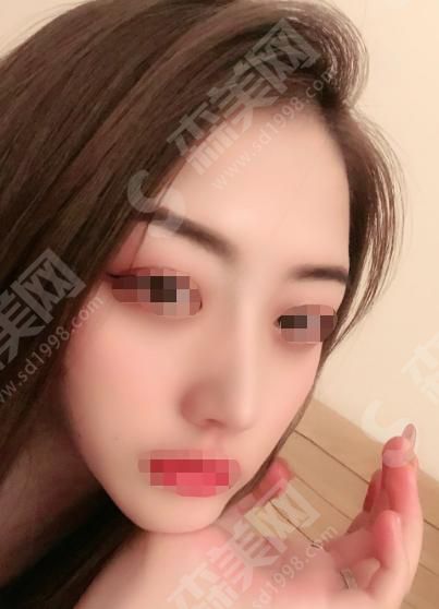 临沂哪家整容医院的口碑好？内含临沂伊维美整形医院隆鼻果分享