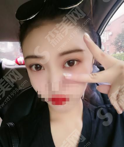 北京哪家整形医院做双眼皮好？内含医院介绍及案例分享