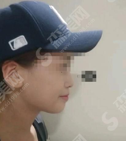 成都军大整形医院正规吗?附隆鼻果图