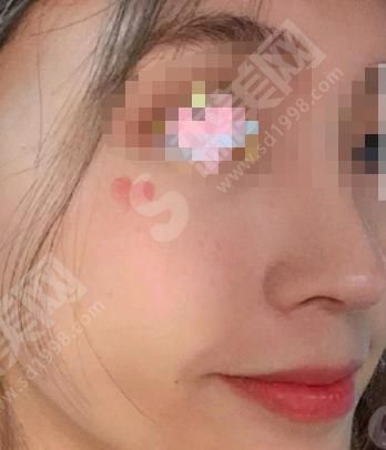 成都军大整形医院正规吗?附隆鼻果图