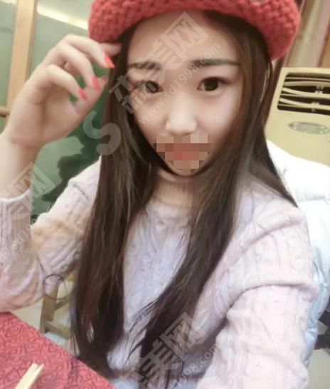 上海九院双眼皮做得怎么样?看看是你期待的果吗~