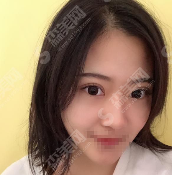 茂名市人民医院整形技术怎么样?内含双眼皮案例分享