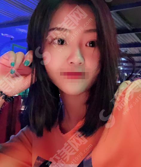 茂名市人民医院整形技术怎么样?内含双眼皮案例分享