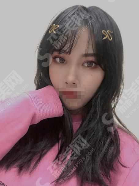 苏州爱思特医疗美容医院双眼皮整形果如何?附恢复果图