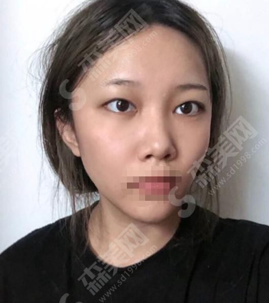 苏州爱思特医疗美容医院双眼皮整形果如何?附恢复果图