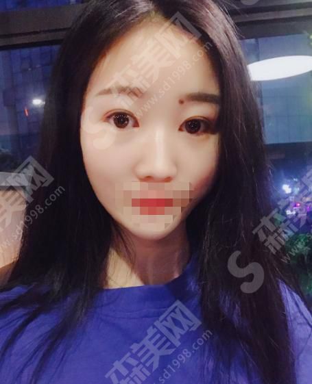 东莞美立方整形医院的双眼皮整形怎么样?来了解一下吧