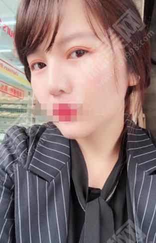 淮安一院整形科隆鼻果好不好?附医生介绍及案例分享