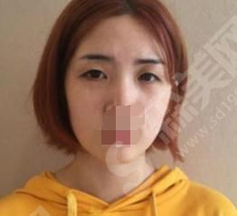 青医附院开眼角果怎么样？附整形价目表