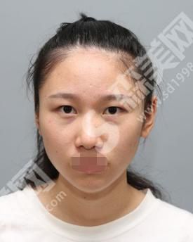 太仓仁慈整形医院做的整形怎么样？真人案例分享来袭！