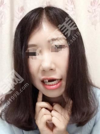 石家庄中诺口腔医院做的种植牙齿怎么样？看看恢复图~