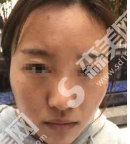 郑州天后整形医院做的鼻子果如何?真人案例带你解析~