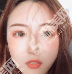 郑州天后整形医院做的鼻子果如何?真人案例带你解析~