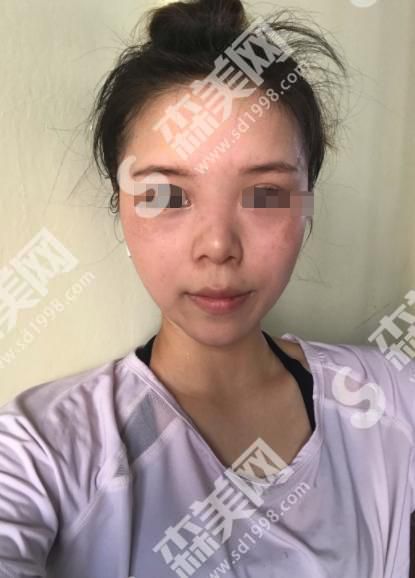 郑州美立方医疗美容医院做的鼻子怎么样?附医师介绍及案例分享