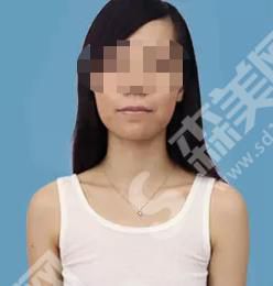 郑州华山医院做的隆胸果如何?真人案例来袭~