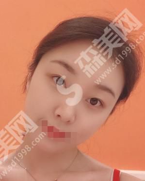 南宁科之美整形美容做的双眼皮怎么样?真人案例分享来袭~