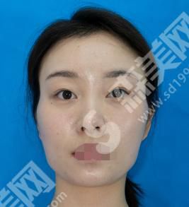 南宁科之美整形美容做的双眼皮怎么样?真人案例分享来袭~