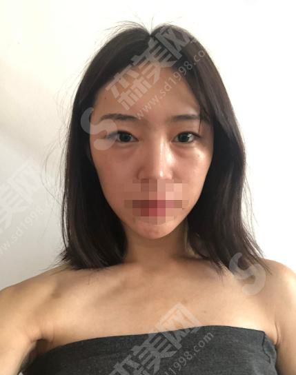 青岛大学附属医院双眼皮手术贵吗？看看医院收费是否合理