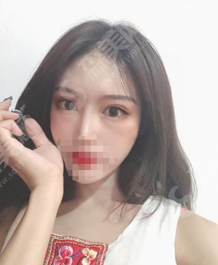 青岛大学附属医院双眼皮手术贵吗？看看医院收费是否合理